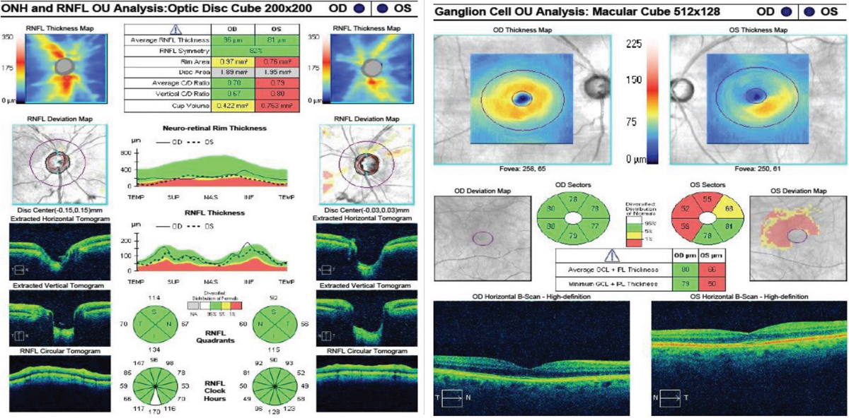 Fig. 2. At left, the RNFL thickness map shows mild superior thinning in the right eye, and notable superior and inferior thinning in the left. The deviation map shows focal superior and temporal thinning in the right. The left is significantly thinner compared with the right average thickness and the superior, inferior and temporal quadrants and wedges. Despite the RNFL showing green in these sections, structural thinning is evident. In the GCC at right, the right eye is within normal limits, whereas the left shows notable thinning to the average GCL thickness, minimum GCL thickness and to the inferior nasal, superior nasal and superior sectors. There is also mild thinning in the superior temporal sector. 