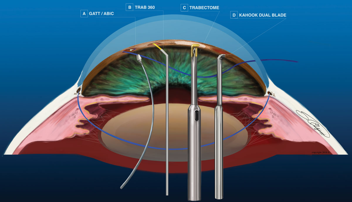 Fig. 2. Rather than use an implanted device, many MIGS use a blade, laser or sutures to complete the procedure.