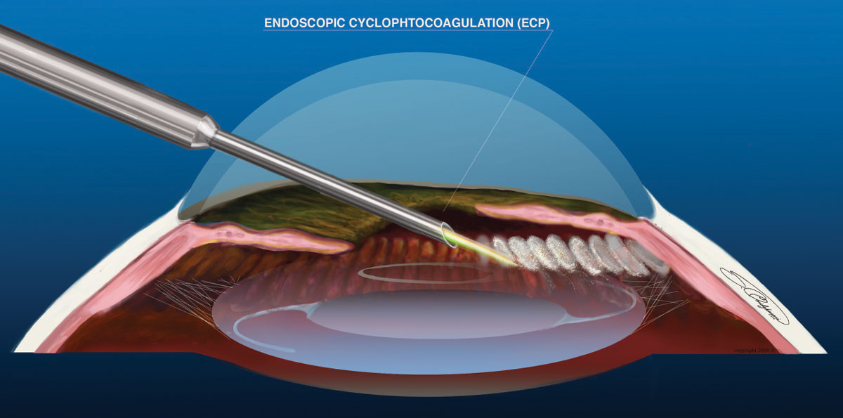 Fig. 3. ECP is the only MIGS procedure that decreases aqueous production.