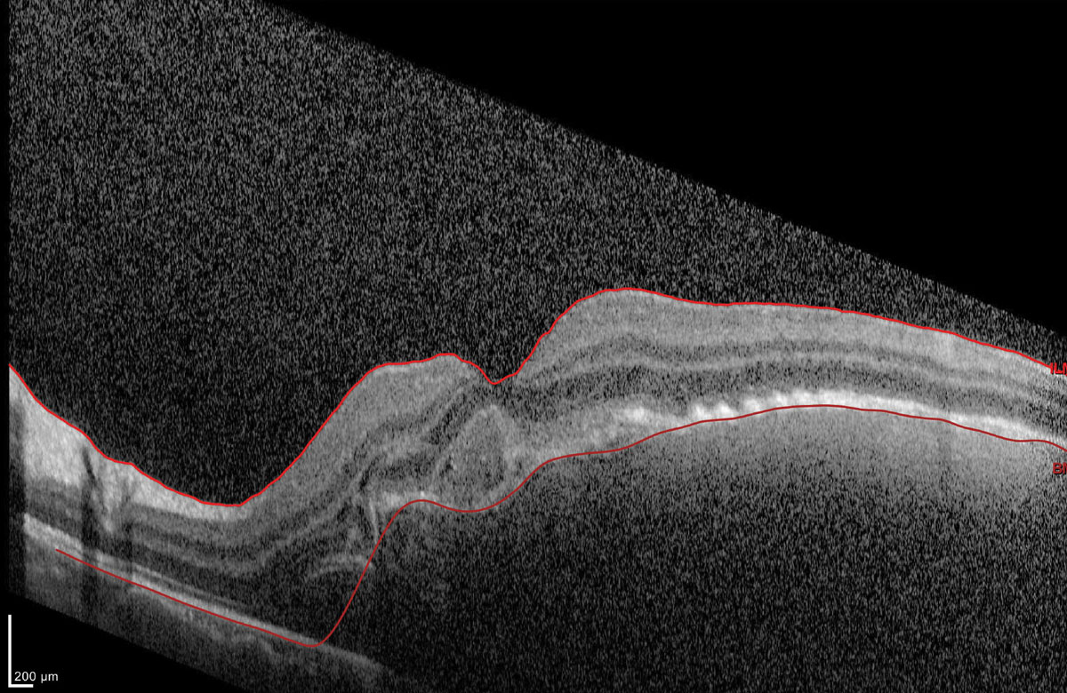 Fig. 2. What can this OCT image tell you about the patient’s macula?