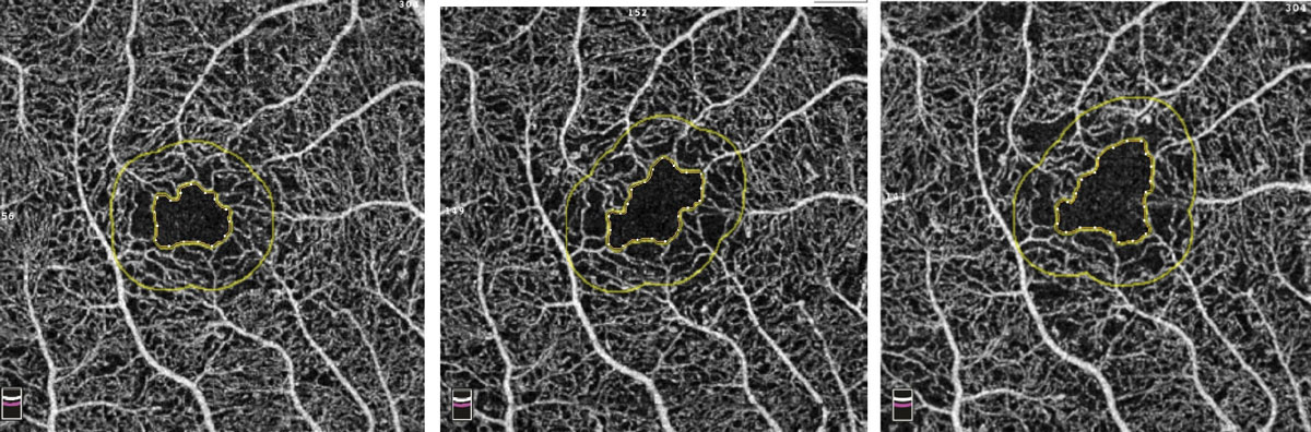 Fig. 9. Example of increasing FAZ over three visits in a patient with diabetes. Photo: Bernard Szirth, OD. 