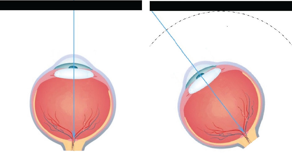 The distance from the eye to the flat panel display is greater at the edge than in the center, resulting in a lower focal demand at the corners and edges than in the center.