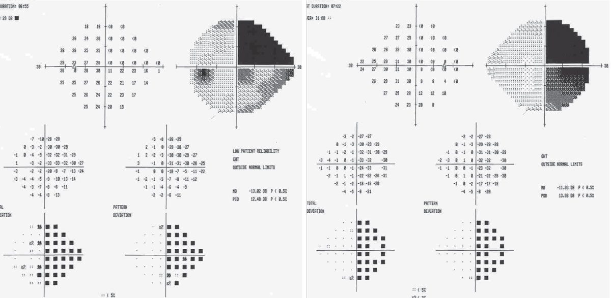 Fig. 1.  Visual field defects may indicate signs of tumor progression in GBM and should prompt further investigation. 