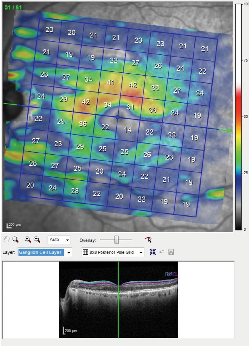 This is the posterior pole map of the ganglion cell layer in the macula of the patients left eye. Though this is the better eye, note the extreme thinning of the ganglion cell layer below the horizontal raphe involving fixation. The same scan of the right eye showed even more damage. With damage to this extent seen structurally, you would expect a superior arcuate visual field defect involving fixation.