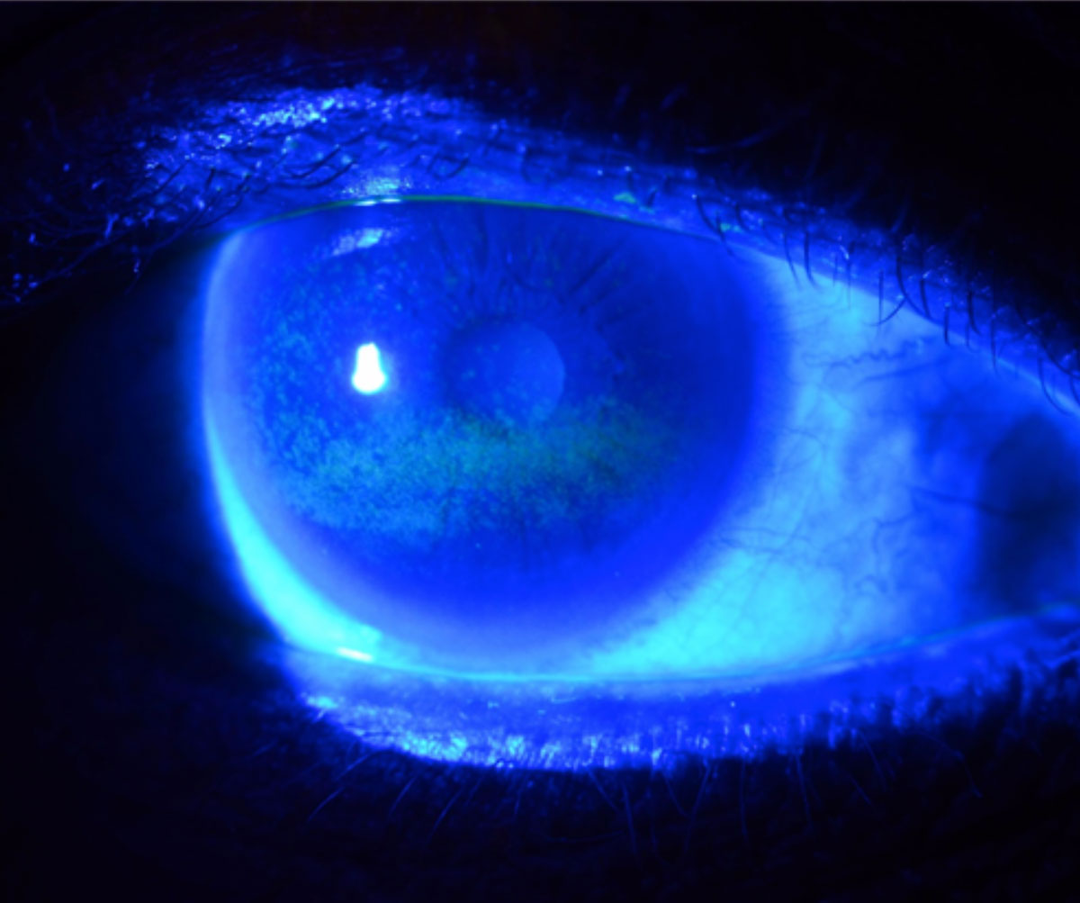 Fig. 1. This is a typical fluorescein staining pattern in a patient with severe dry eye from Sjögren’s syndrome. 