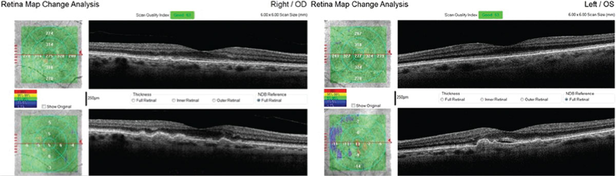 This 71-year-old Caucasian female with small, hard drusen OU had abnormal dark adaptation and was diagnosed with AMD in 2016 (top OCT images). Even with treatment, the size and number of her drusen worsened and her dark adaptation progressed over time. She was being monitored routinely with dilated examinations every three months due to this quick progression and high risk of converting to wet AMD. On one of these routine exams, her visual acuity was 20/25-1 OD and 20/25+2 OS. She had no symptoms to report, and her Amsler grid had been stable during both at-home and in-office testing. Dilated exam revealed macular thickening OS, which was confirmed as subretinal fluid on OCT. The patient was referred to a retinologist who confirmed the presence of CNV with fluorescein angiography and initiated anti-VEGF treatment the same week. Today, her visual acuity remains 20/25 OS and she is still asymptomatic (bottom OCT images).