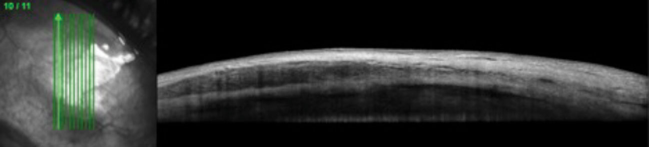 This 51-year-old female with a systemic history of rheumatoid arthritis was diagnosed with nodular anterior scleritis. Anterior segment OCT through the scleral nodule superior nasal OD demonstrates low reflectivity spaces consistent with edema.