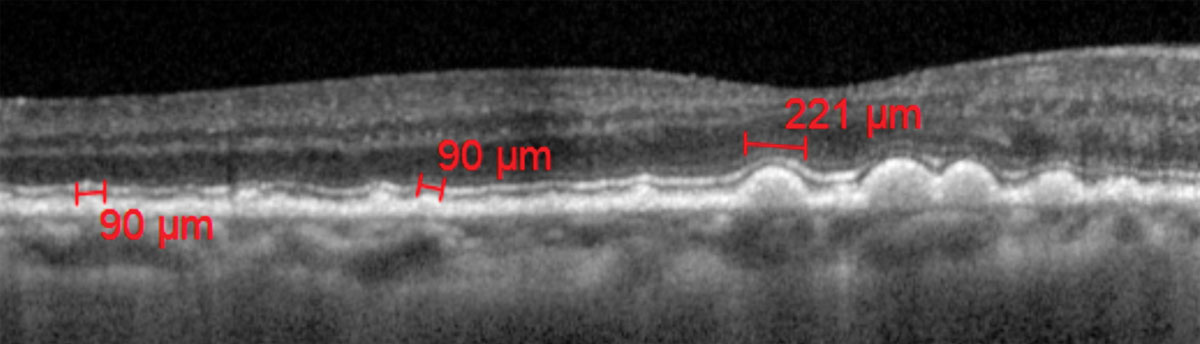 Fig. 1. Drusen size measured with calibers on OCT.