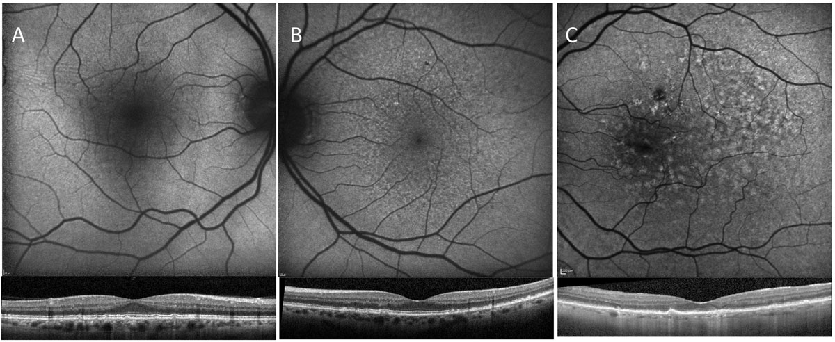 Fig. 3. The top FAF images correspond with the OCT B-scans below. With OCT imaging, all of these patients have presence of intermediate sized drusen; however, patient A has much less disruption of the autofluorescent signal than patients B and C, suggesting the overall health of the RPE in patient A is better than that of B and C. 