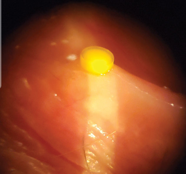 Fig. 1. Dextenza could be a promising alternative or adjunct to drops in treating anterior uveitis.