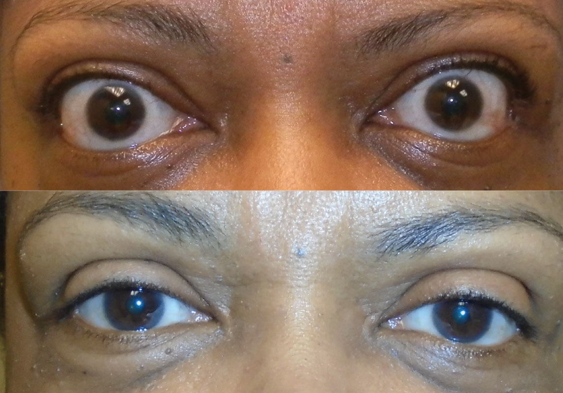 Fig. 6. Before (above) and after (below) orbital decompression of a patient in the stable, inactive phase. 