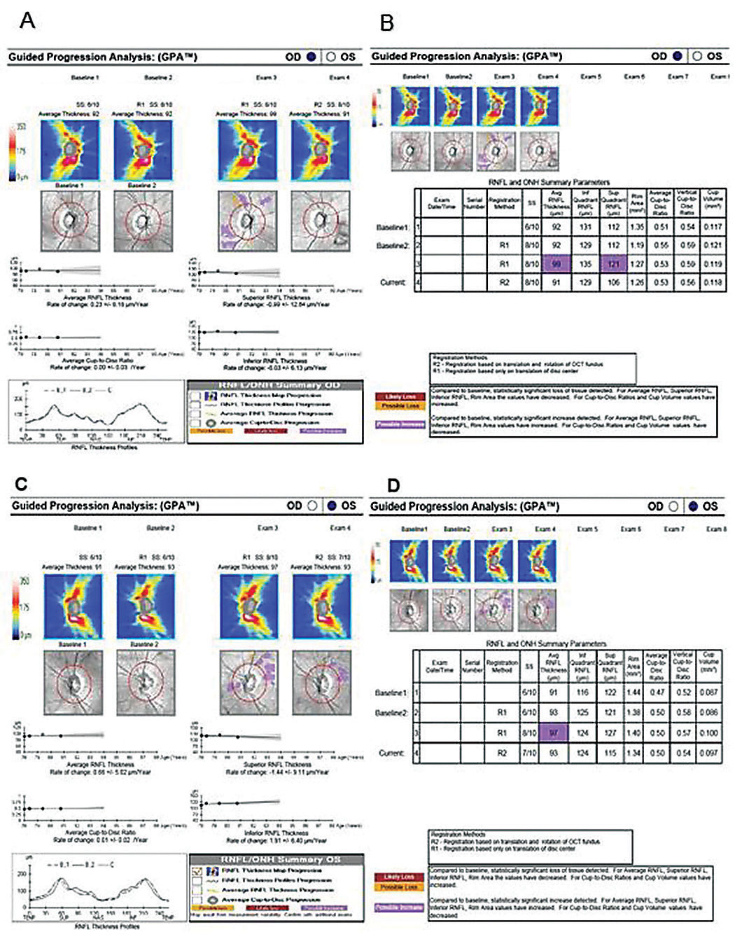 RNFL guided progression analysis OD (A) and OS (C) shows stable RNFL thickness slopes. Furthermore, the RNFL and ONH parameters remain stable OD (B) and OS (D).