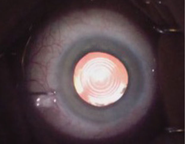 Most patients (94%) are very satisfied with the new PanOptix trifocal IOL. 