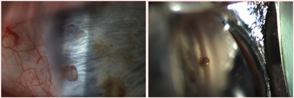 An appropriately positioned CyPass stent in the nasal angle, as shown here, in a patient with a healthy endothelium is unlikely to cause corneal edema.