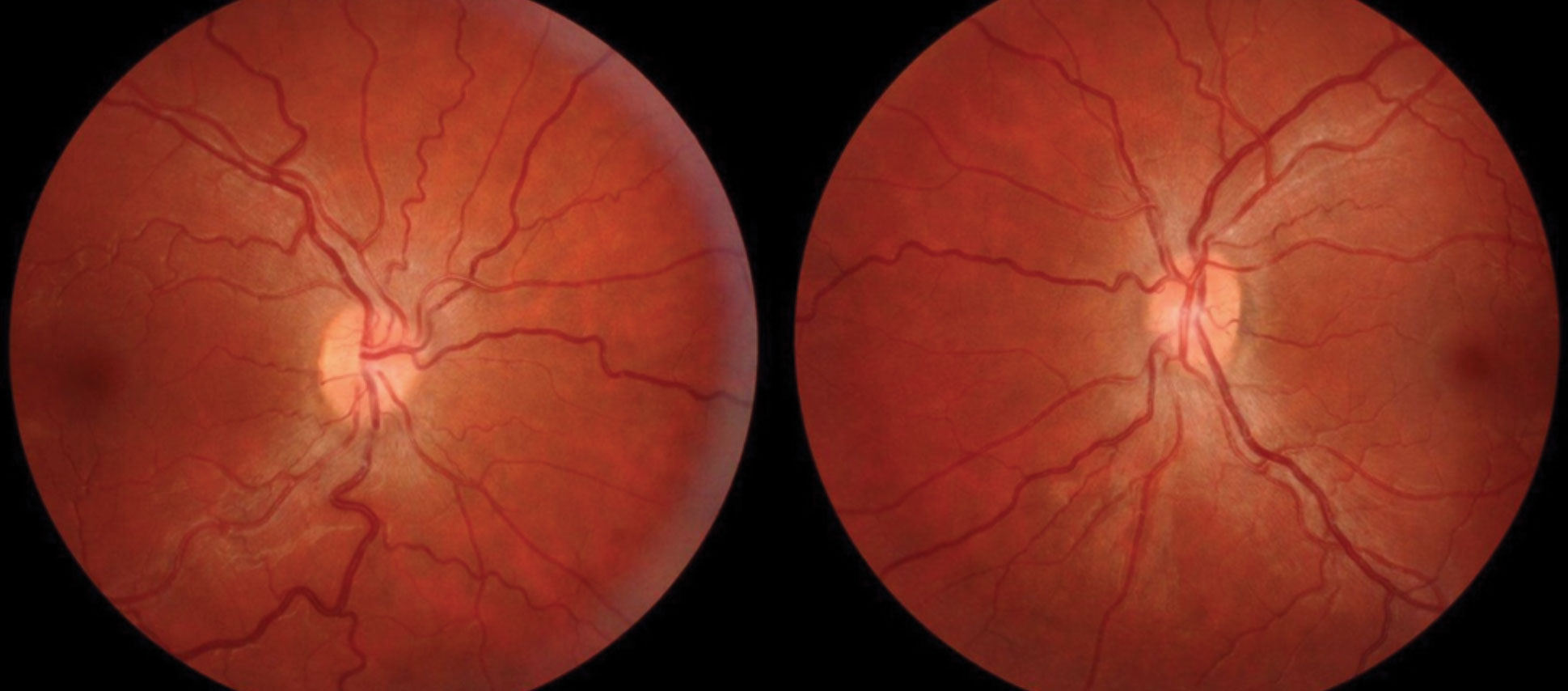 Fig. 4. Conditions that increase the production, or decrease the outflow, of cerebral spinal fluid can lead to papilledema, as seen in this patient’s fundus.