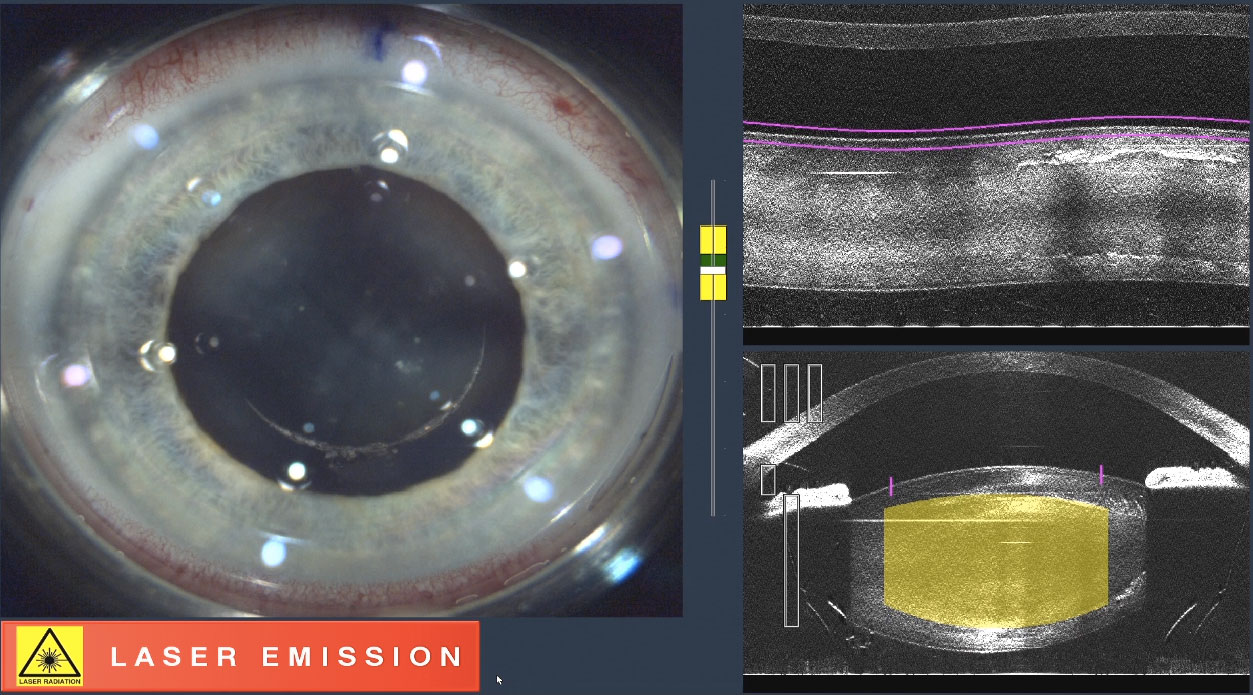 Here, the femtosecond laser is creating a capsulorhexis.