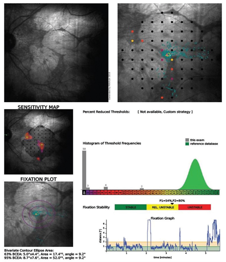 Fig. 1. This microperimetry readout shows a case of a spared channel of central vision in a patient with macular telangiectasia.