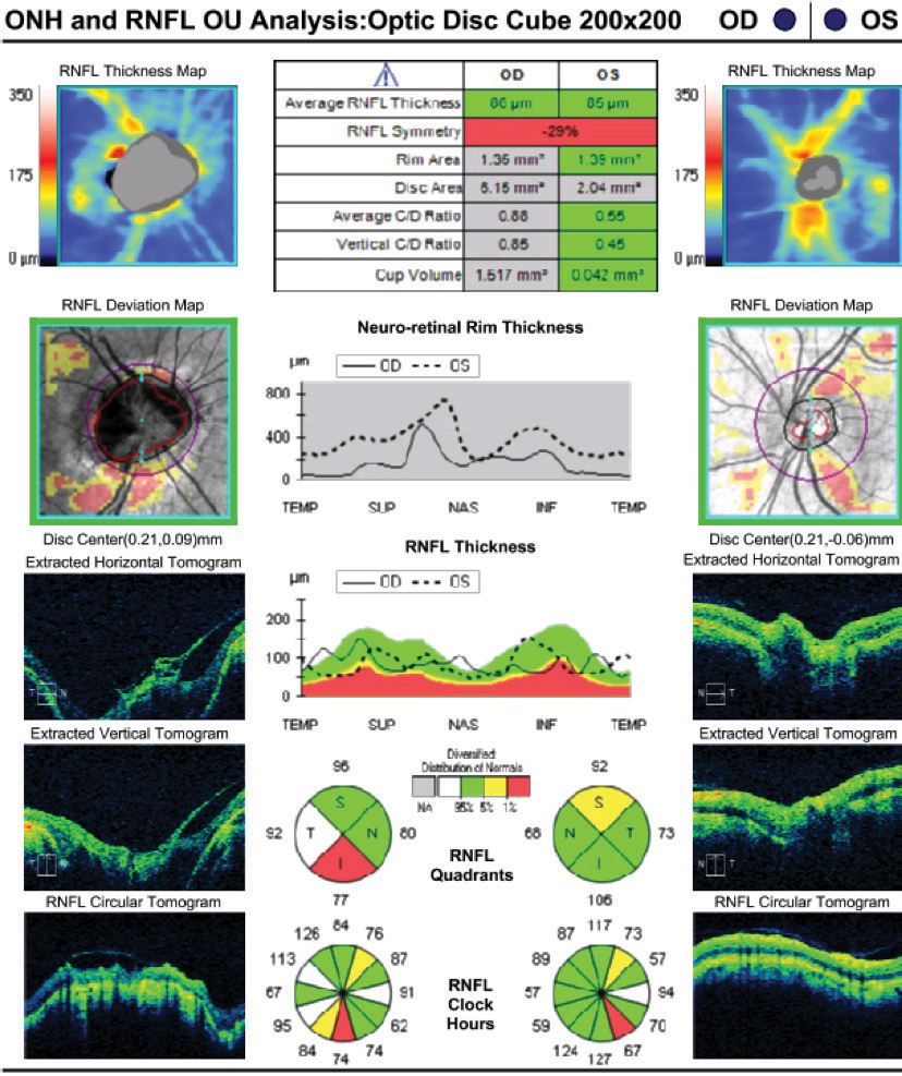 Fig. 2. OCT revealing enlarged disc area of the right optic nerve and excavation.