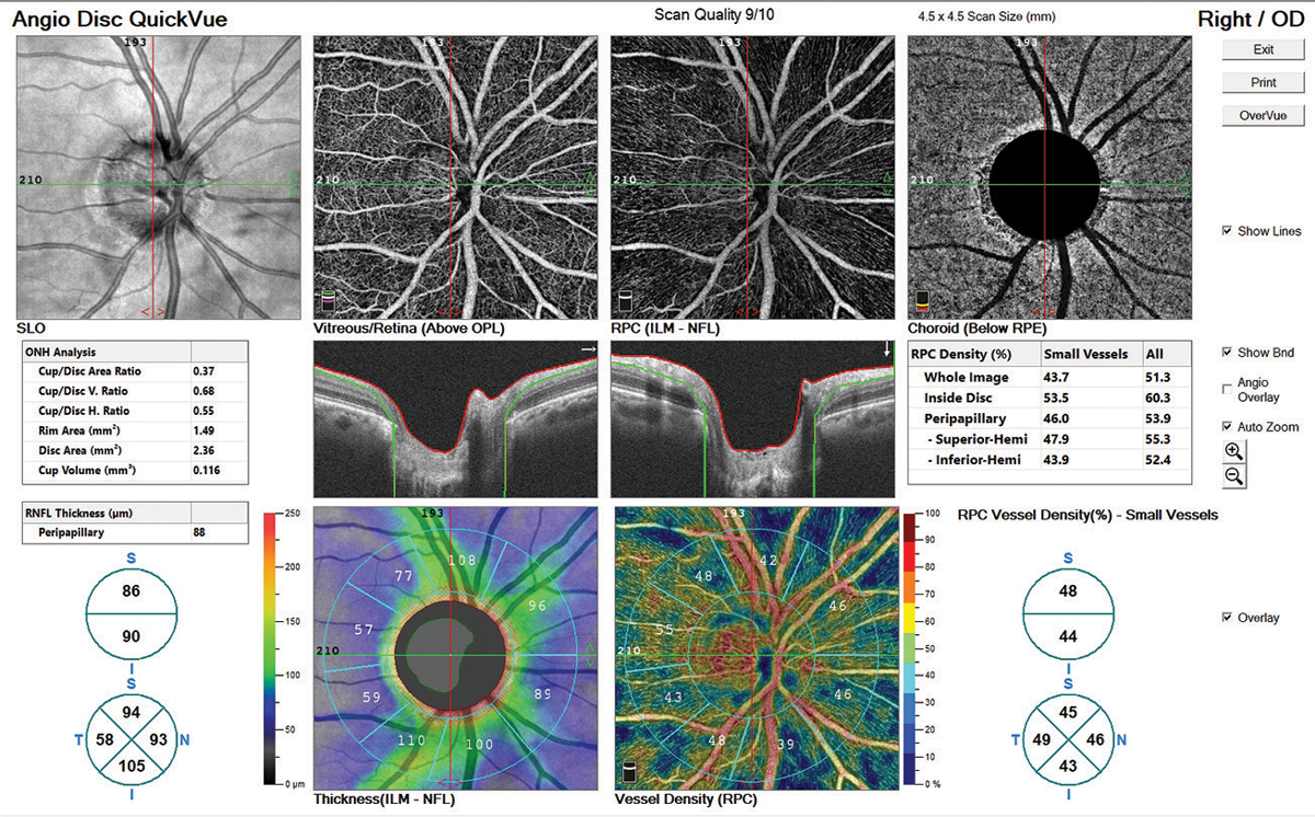 Fig. 8. The AngioVue software rendered the vascular network in rich detail. Note the capillary dropout in the vessel density map, which corresponds to the RNFL dropout. While the clinician would arrive at the same awareness of nerve fiber loss without OCT-A, it aids confirmation.