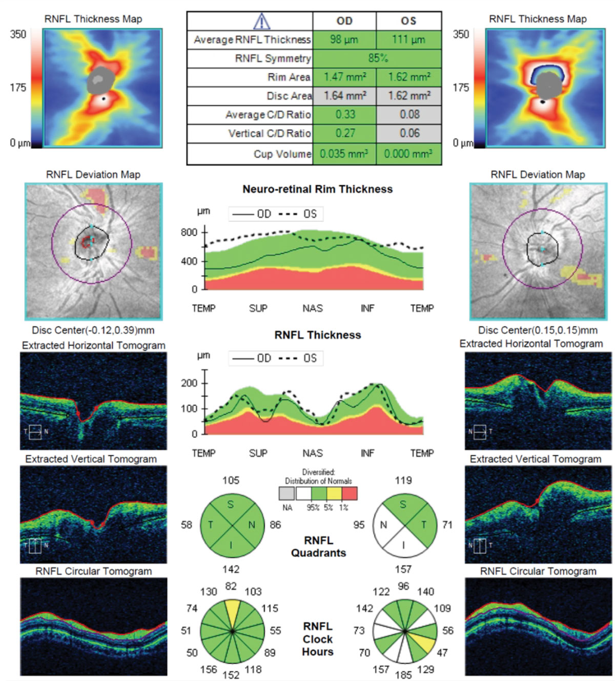 Fig. 1. These SD-OCTs of the patient’s optic nerves and RNFL cube shows substantial elevation of her left eye’s neuroretinal rim tissue. The extracted tomograph highlights the large elevation asymmetry between the eyes.