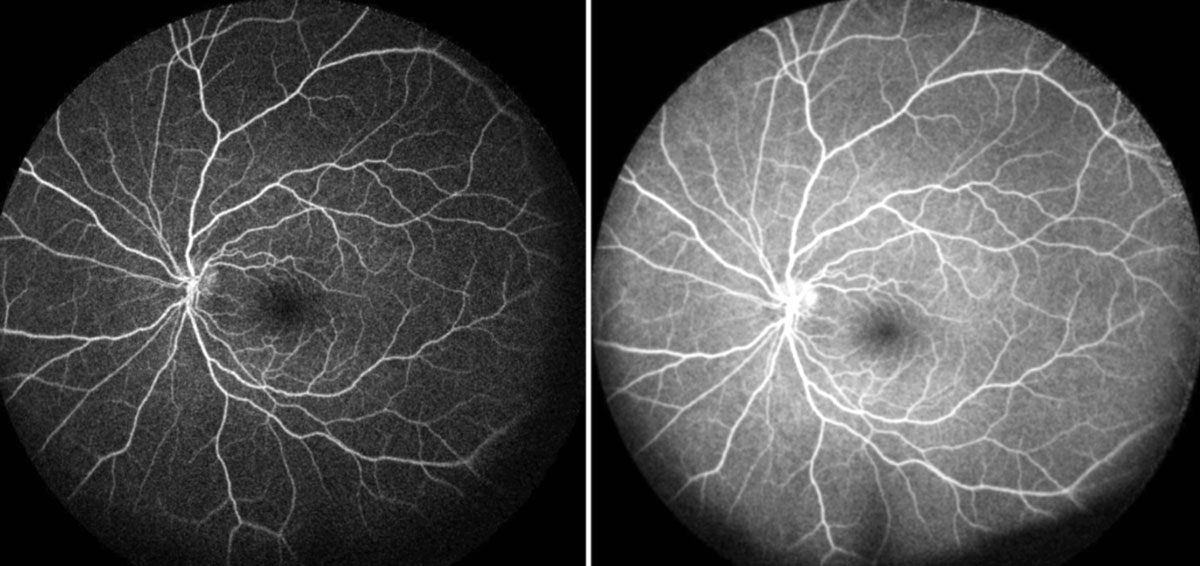 Fig. 4. Her left eye shows hyperfluorescent staining/pooling of the disc during the early and mid-phase.