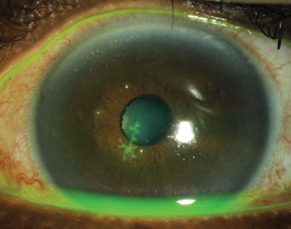 Fig. 3. Clinicians should avoid prescribing steroids for an epithelial herpetic infection, but they are helpful for cases of stromal herpetic keratitis.