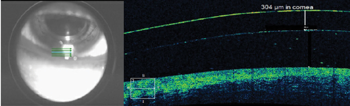 Fig. 4. The scleral lens thickness at the inferior limbus is thicker than the manufacturer-listed center thickness for this low-powered lens. 