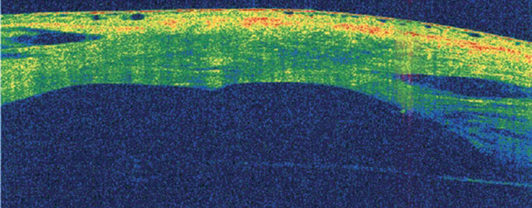 Fig. 10. AS-OCT is useful for monitoring the healing process of acute corneal hydrops.