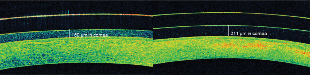 Fig. 8. AS-OCT identified significant post-scleral lens tear layer debris that was causing subtle but bothersome foggy vision.