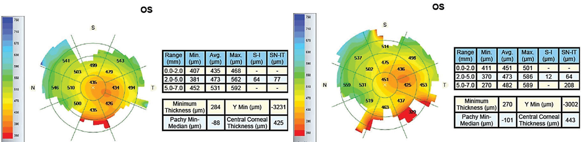 Fig. 9. Pre-scleral lens wear (left) and post-two hours of lens wear imaging (right) of an advanced keratoconus patient with a history of acute hydrops and pathological edema indicated central corneal swelling.