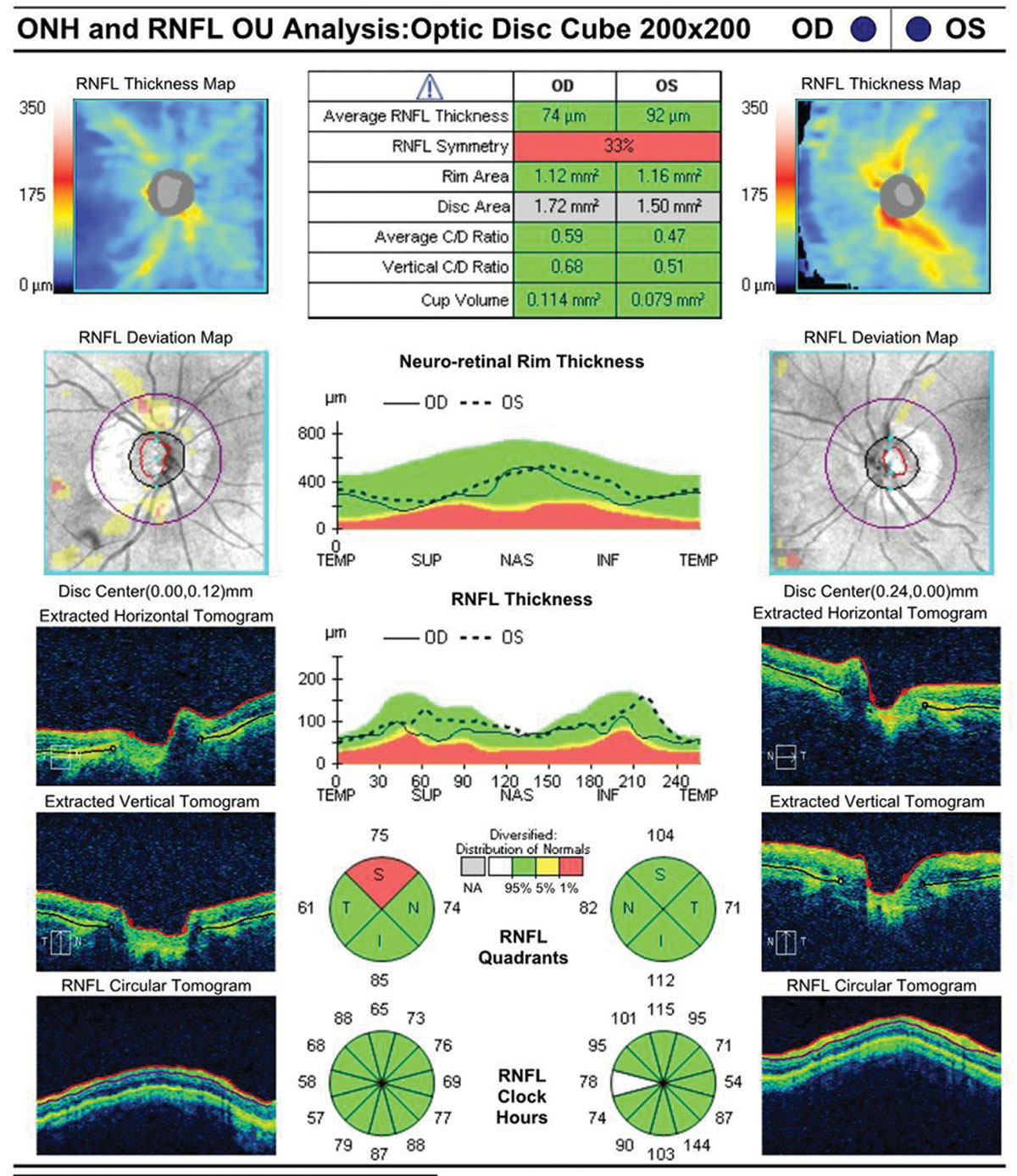 Fig. 1. This 92-year-old white female is currently taking latanoprost OU at bedtime. She has a maximum IOP of 22mm Hg with an IOP on exam of 18mm Hg OU. Corneal thicknesses are 523µm OD and 520µm OS. The patient’s testing shows only mild visual field loss. Given her age and clinical picture, it is unlikely she will experience real functional impairment in her lifetime. A mild (even if confirmed) progression of RNFL loss might not be an indication to escalate therapy.