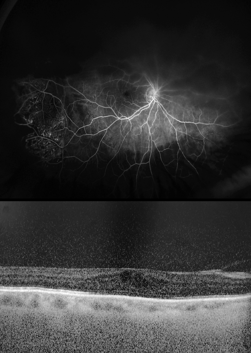 Figs. 3 and 4. In the above fluorescein angiogram, the patient’s aneurysmal dilations and leakage are visible. Below is an OCT.