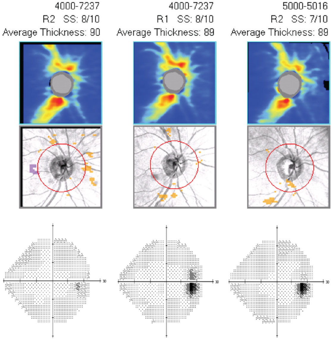 Case 6. This is the guided progression analysis (optic nerve head OCT) with visual fields (right eye only) of a 43-year-old black male who has been treated with Vyzulta for 25 months in both eyes. IOP has decreased 40% and has been consistent at follow ups since initiating the drug. His OCT and visual fields show no change over the 25-month period, indicating successful treatment.