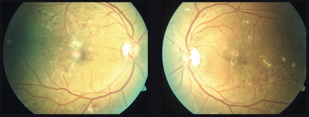 This 55-year-old patient with diabetes developed significant bilateral DME over six months. Some patients who take statins are less likely to develop DME.