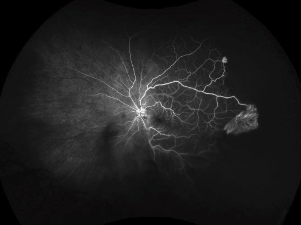 Fig. 2. The ultra-widefield FA shows our patient’s right eye in mid phase, at left, and left eye in the early phase.