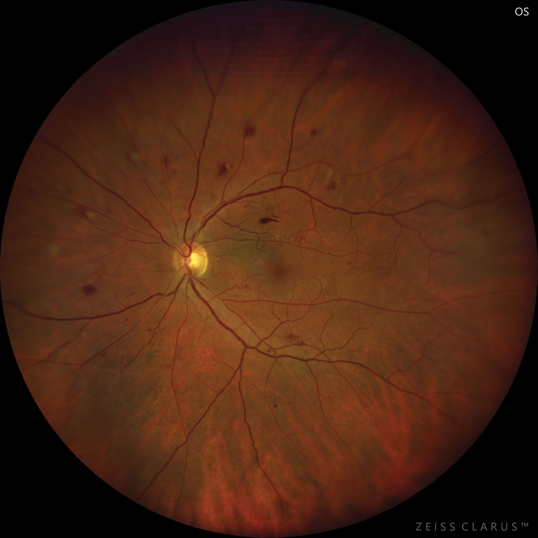 Moderate NPDR care consists of several management techniques, as there is currently no treatment.