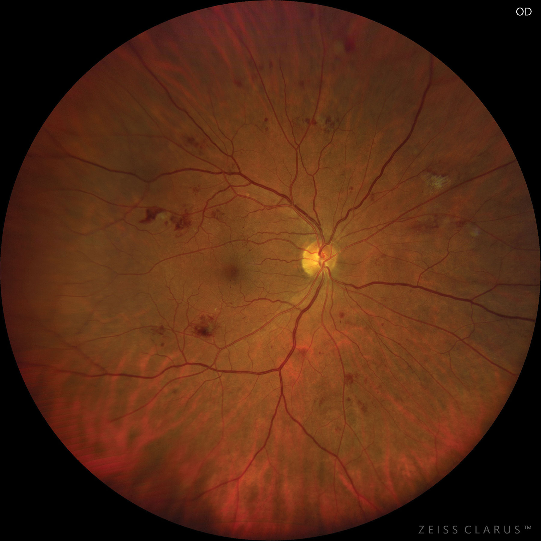 Anti-VEGF may help improve visual outcomes for cases of moderate to severe NPDR.