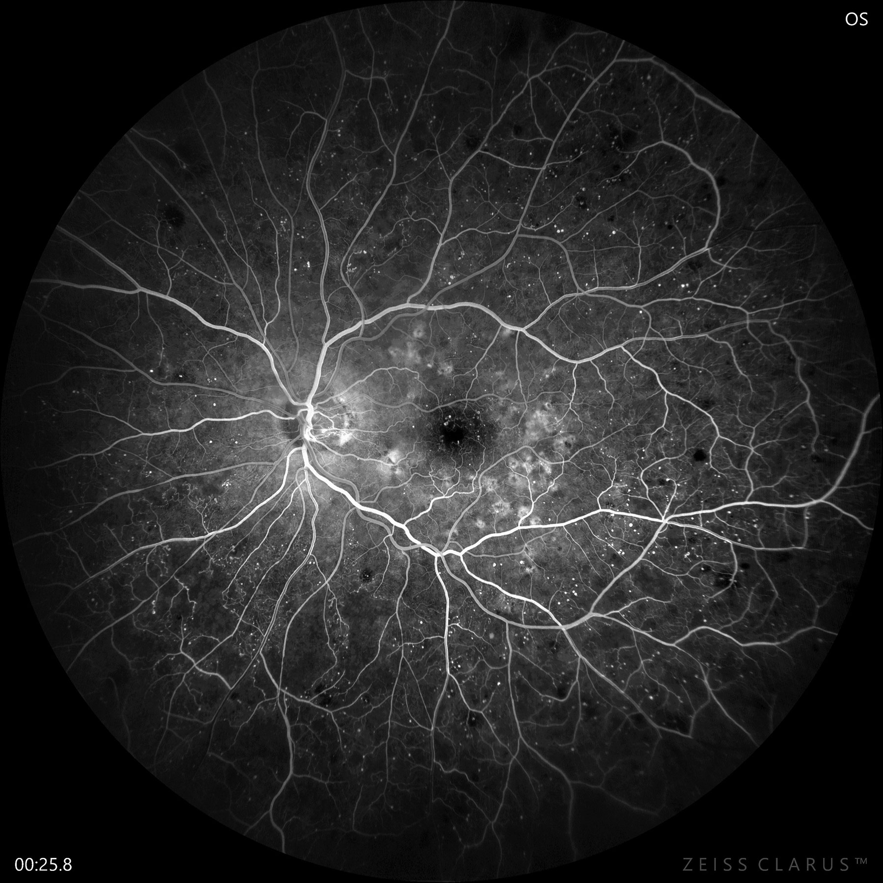 Fluorescein angiography confirms early PDR with significant non-perfusion and neovascularization of the disc.