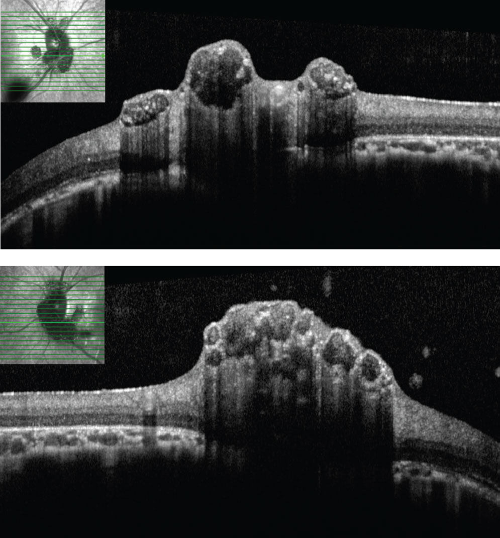 Figs. 3 and 4. SD-OCT through lesions of the right optic nerve. On SD-OCT, the lesions appear to have hypo-reflective “moth eaten,” optically empty spaces with foci of hyperreflectivity, likely reflecting areas of intralesional calcification.