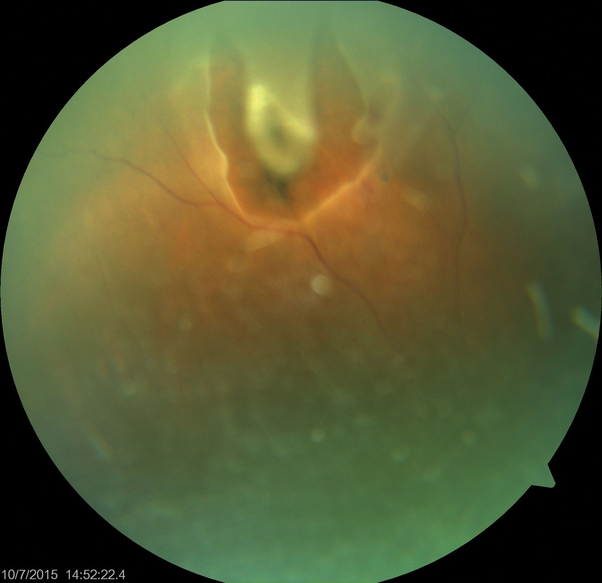 Although this patient only presented for near vision blurring, imaging found something more pressing. Do you recognize this presentation?