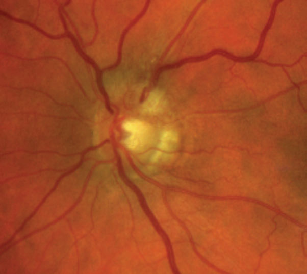 Imaging reveals superior neuroretinal rim elevation with telangeictatic vessels.