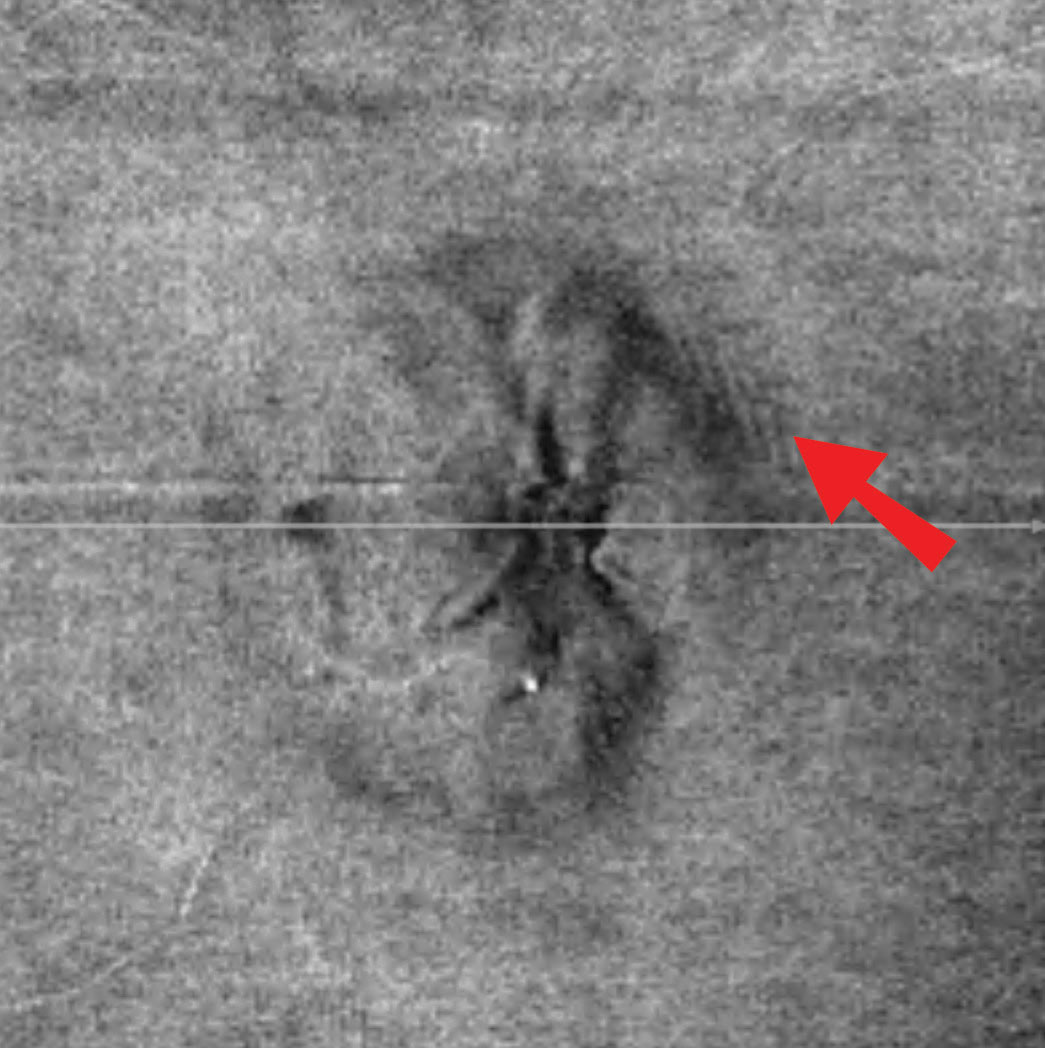 In this patient’s en face OCT vitreoretinal interface image of the left eye, note the wrinkles superior temporal, consistent with Paton’s lines or peripapillary wrinkles that are not readily visible funduscopically.