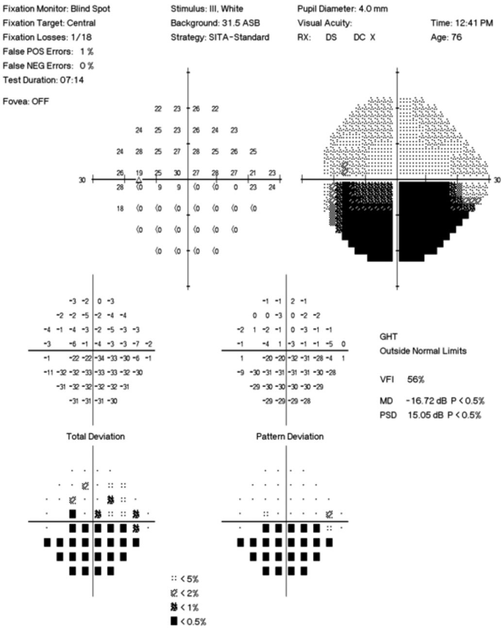 The 24-2 automated visual field demonstrates an inferior defect OS.