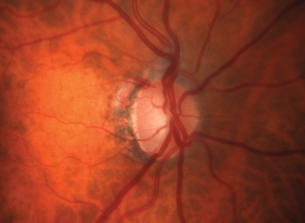 This patient was on two topical meds for her glaucoma, a prostaglandin analog and a fixed-dose combination (brimonidine/timolol), and had SLT within the last year. IOP was 20mm Hg when this disc hemorrhage was noted in the right eye. The patient declined surgical options. Rocklatan (netarsudil/latanoprost) was prescribed (one drop every evening) as a substitute for the PGA. The IOP was reduced to 16mm Hg.