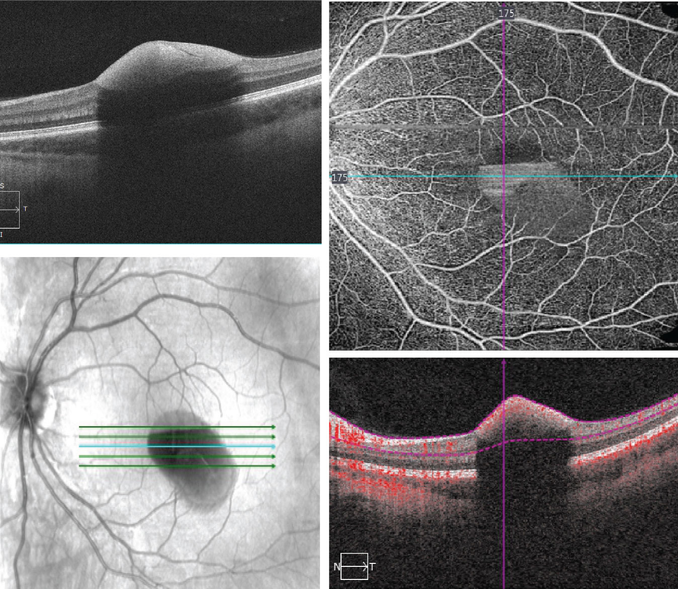 The SD-OCT (left) and OCT-A (right) of the left eye. The OCT-A is an 8mm x 8mm superficial cut through the macula. What does it show?