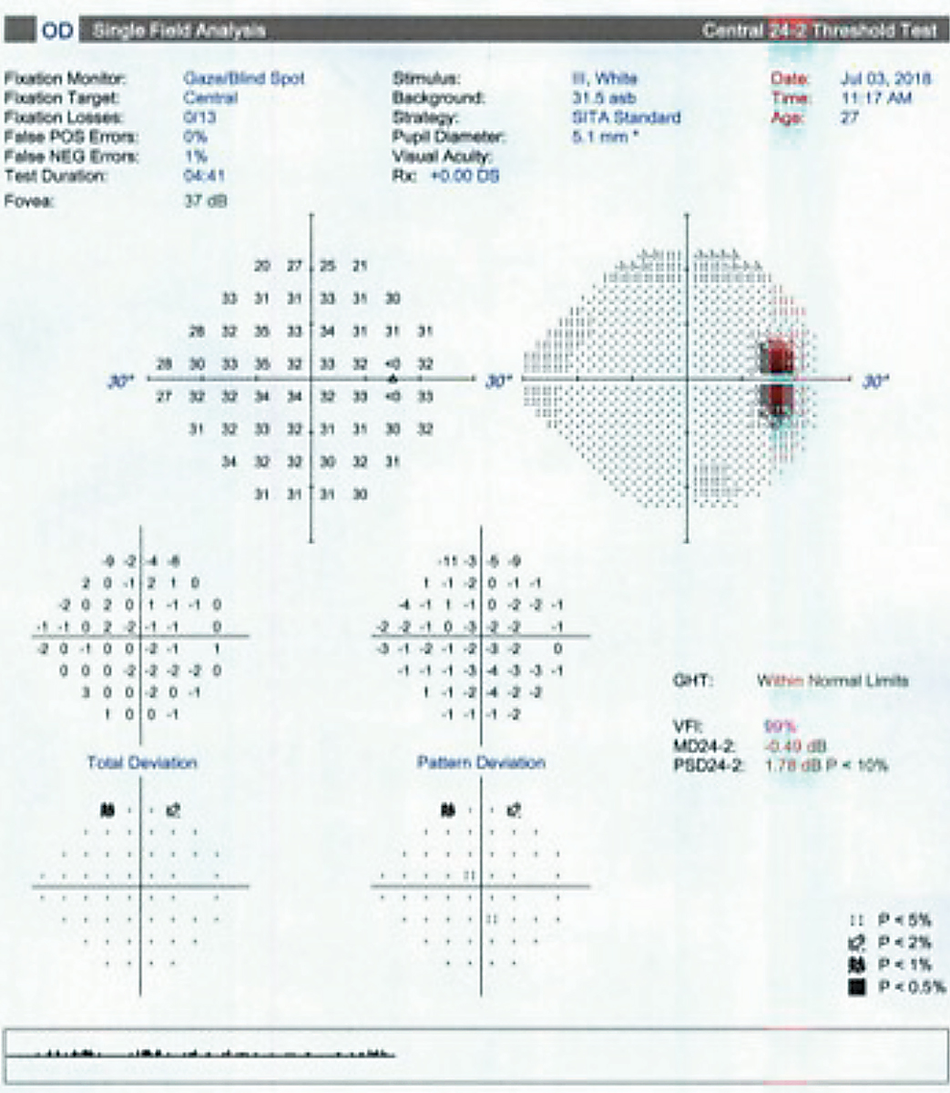 Ocular hypertension patients usually have visual fields with normal sensitivity and variability only slightly higher than in normal subjects.