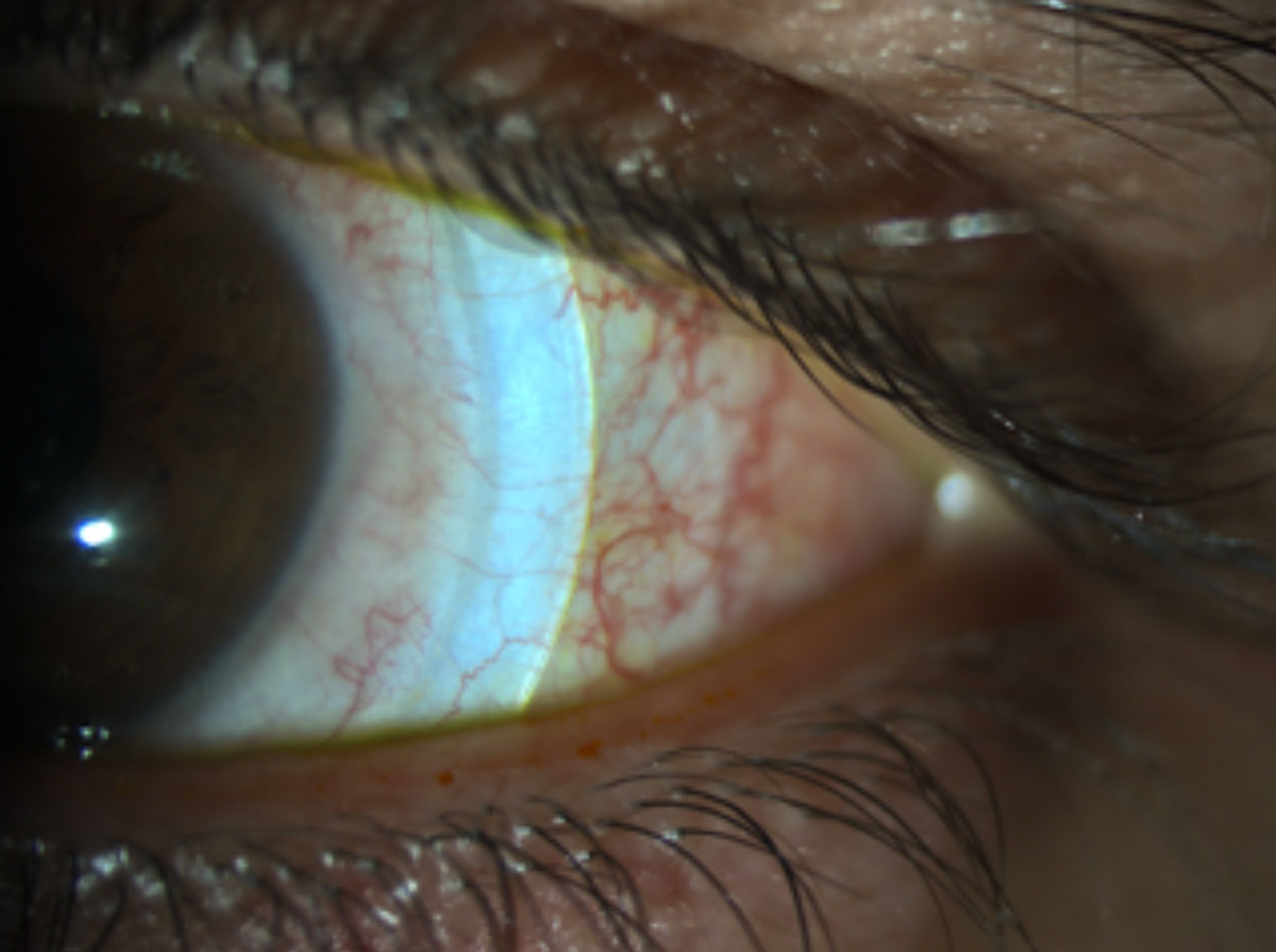 Fig. 3. Blanching occurs under the peripheral curves and can cause limbal vessel engorgement.