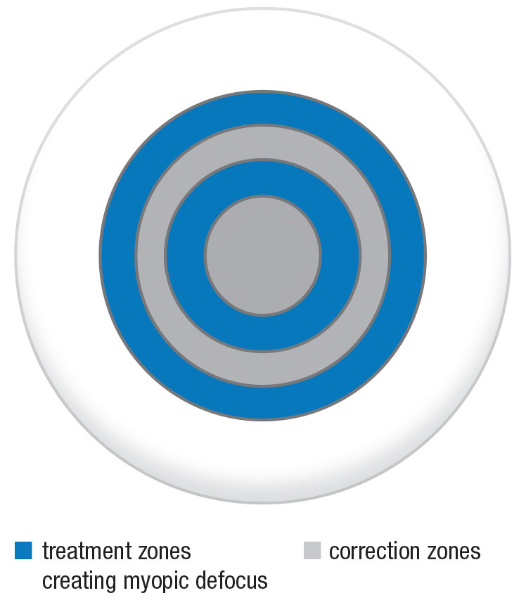 Fig. 2. The MiSight lens has two treatment zones, creating a peripheral myopic defocus that causes the image to focus in front of the retina and slow axial elongation. Myopia is corrected in all gaze positions. Image: adapted from CooperVision.