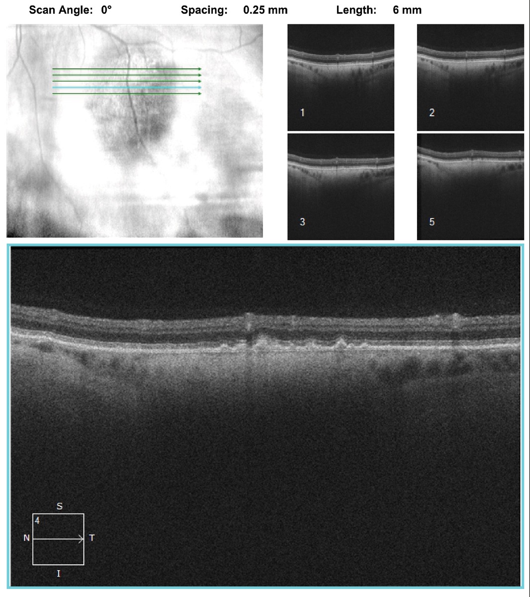 Fig. 3. Note the changes in the choroid on the OCT through the lesion. What do they represent? 