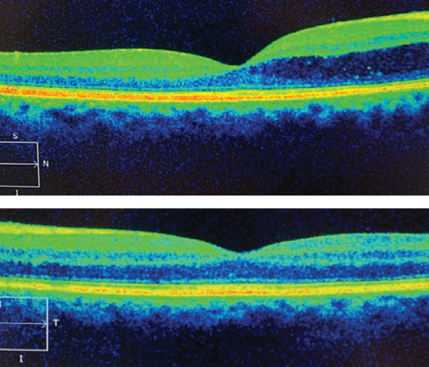 There was fluid egression into the macula OD, top, not OS.